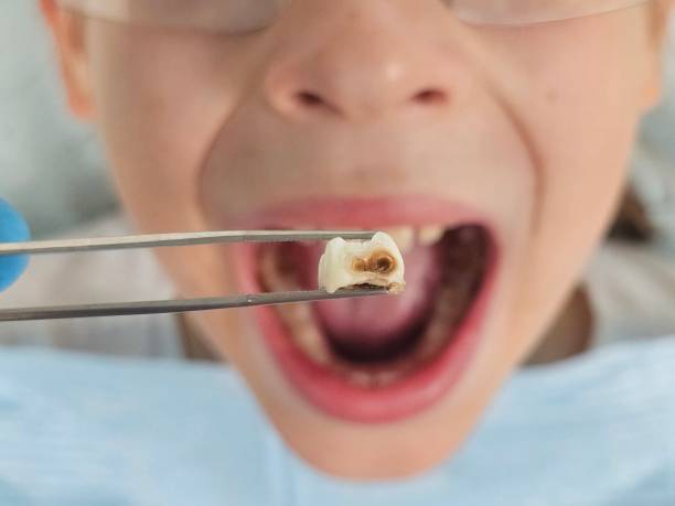 Best Dentist for Severe Toothache  in Fort Meade, FL